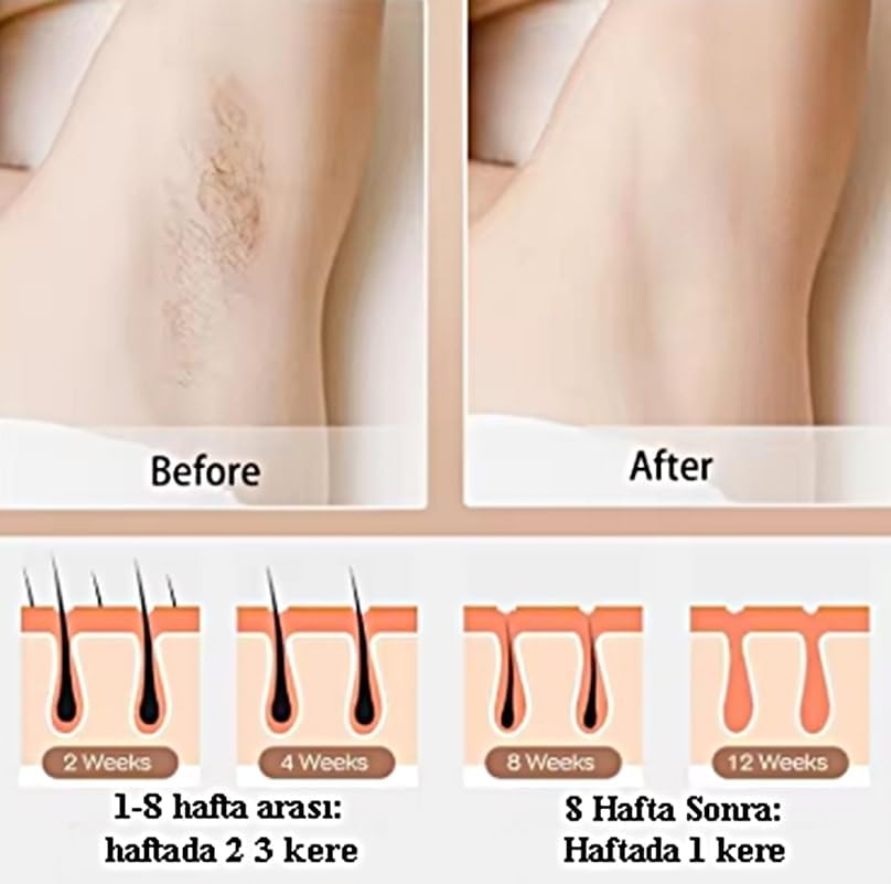 Buz Lazer Epilasyon 999.999 Atım- Cilt Gençleştirici- Giderici- Lazer Epilasyon Aleti